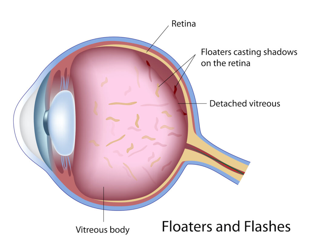 Diagram showing the causes of flashes and floaters.