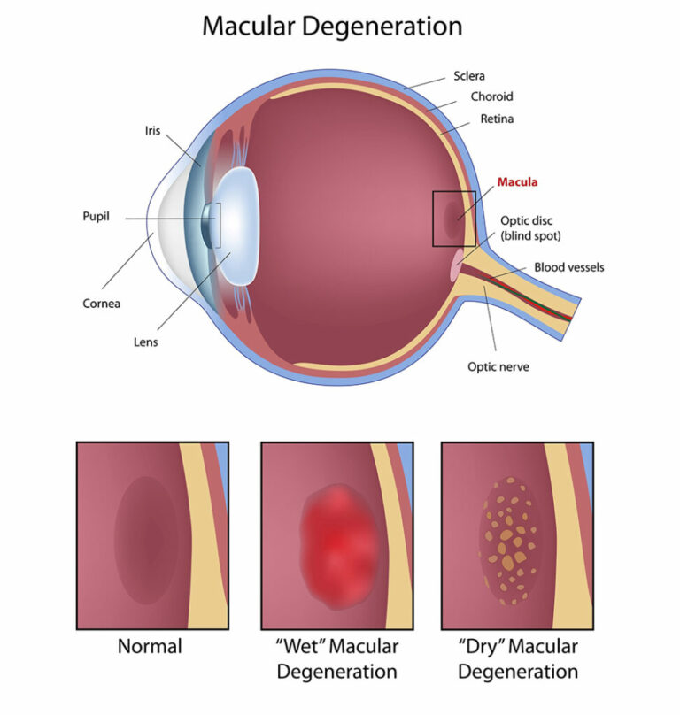 Macular Degeneration Pittsburgh, PA Scott & Christie Eyecare